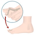 Hammer toe deformity. Medical poster. Royalty Free Stock Photo